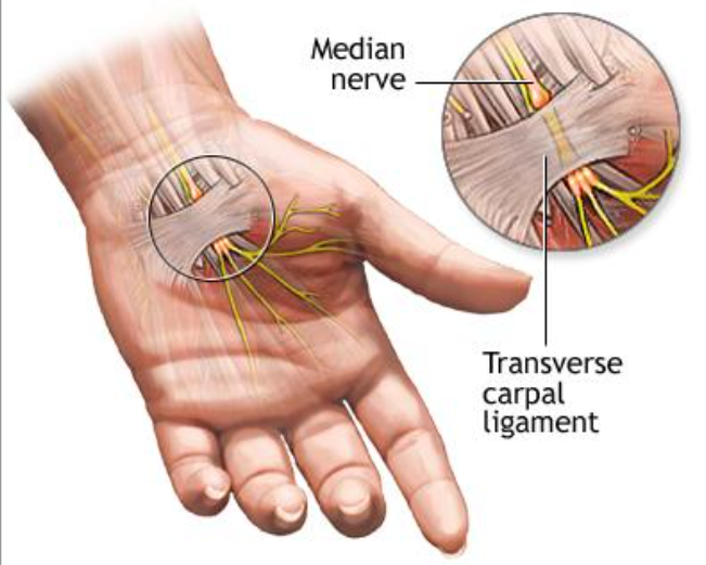 Carpal Tunnel Syndrome