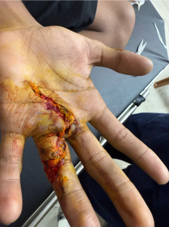 Bandaged hand recovery