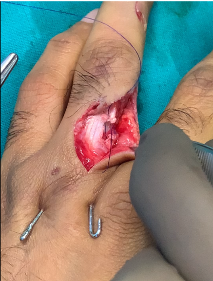 Hand fracture reference x-ray