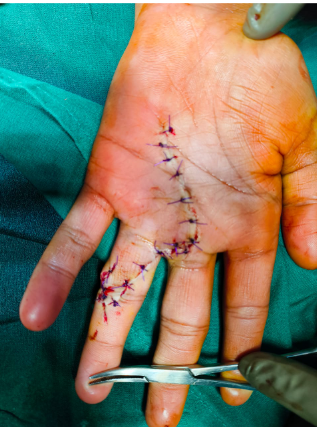 Crush Hand Injury