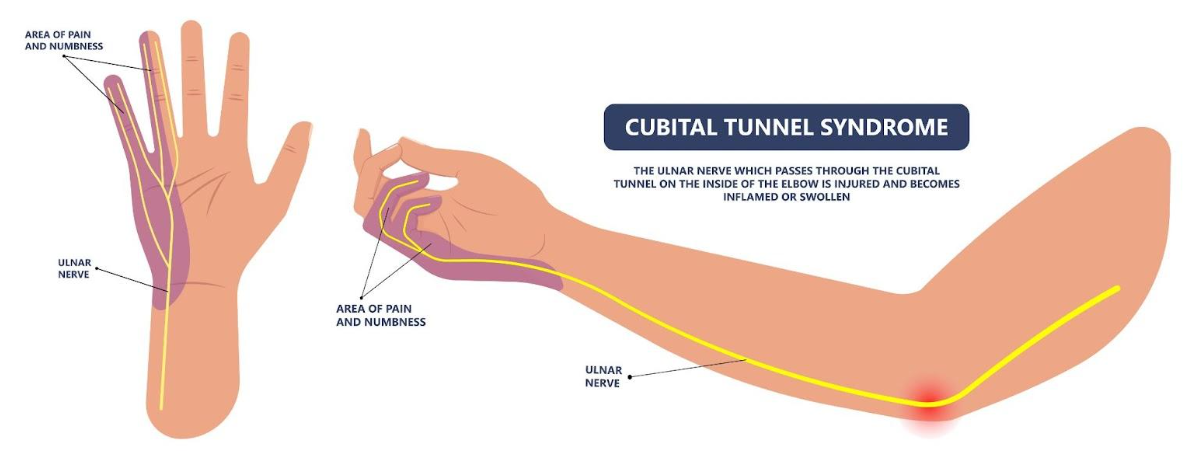 Cubital Tunnel Syndrome