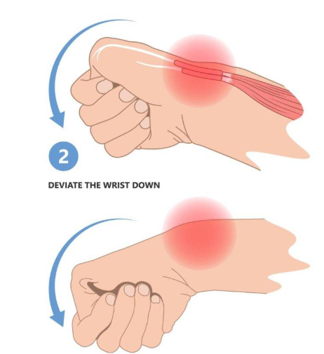 De Quervain's Tenosynovitis