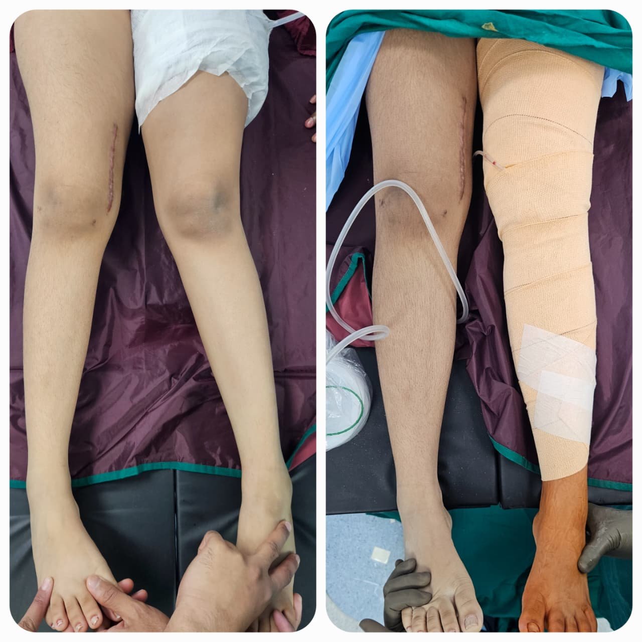 Knock Knees Correction