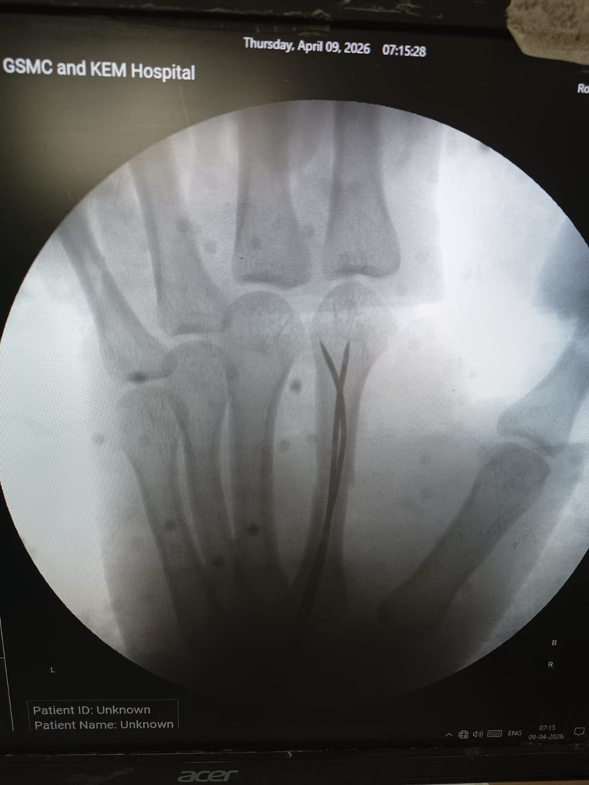 Minimally invasive fixation for Hand fracture