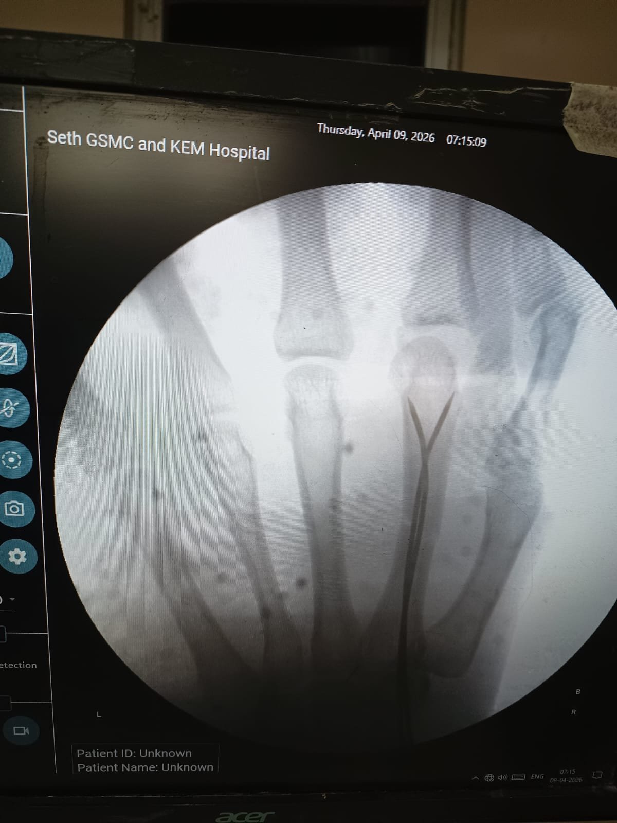 Minimally invasive fixation for Hand fracture