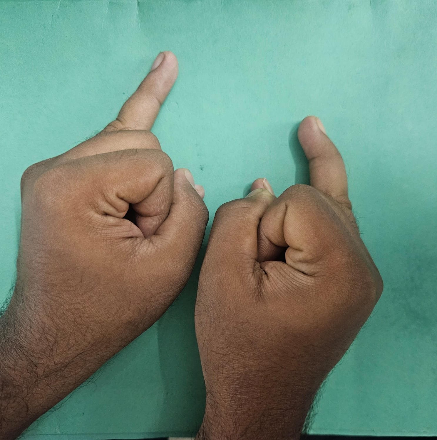 Clinical images for mallet finger
