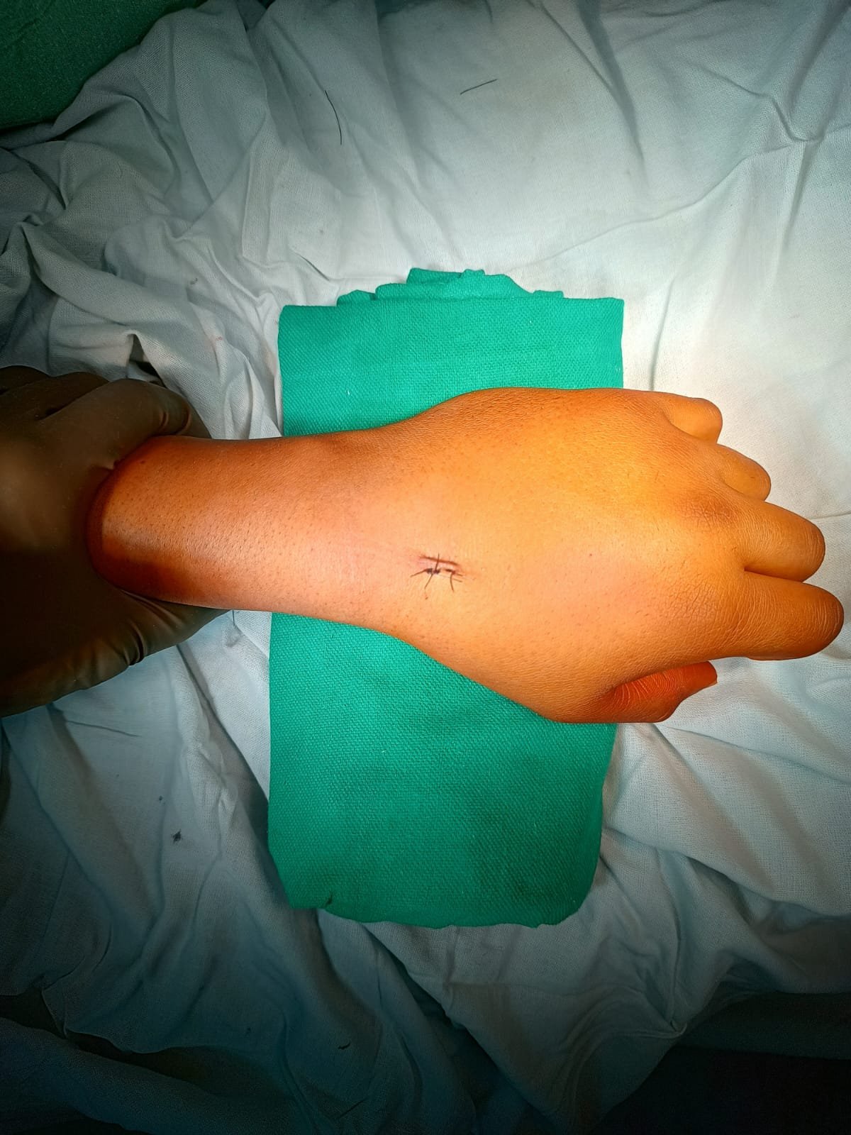 Minimally invasive fixation for Hand fracture