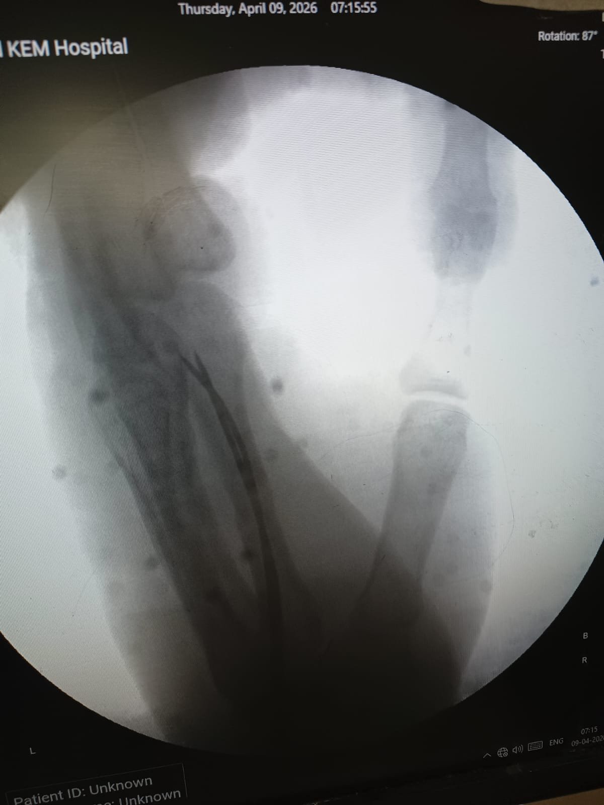 Minimally invasive fixation for Hand fracture