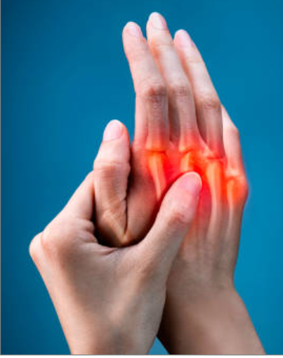 Arthritis of Small Joints