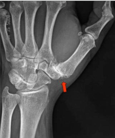 Thumb Base Arthritis